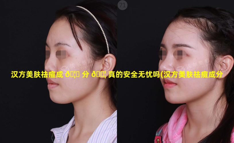 汉方美肤祛痘成 🦍 分 🐦 真的安全无忧吗(汉方美肤祛痘成分真的安全无忧吗怎么样)